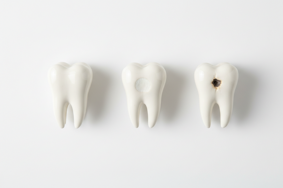 What Happens During Enamel Demineralization?