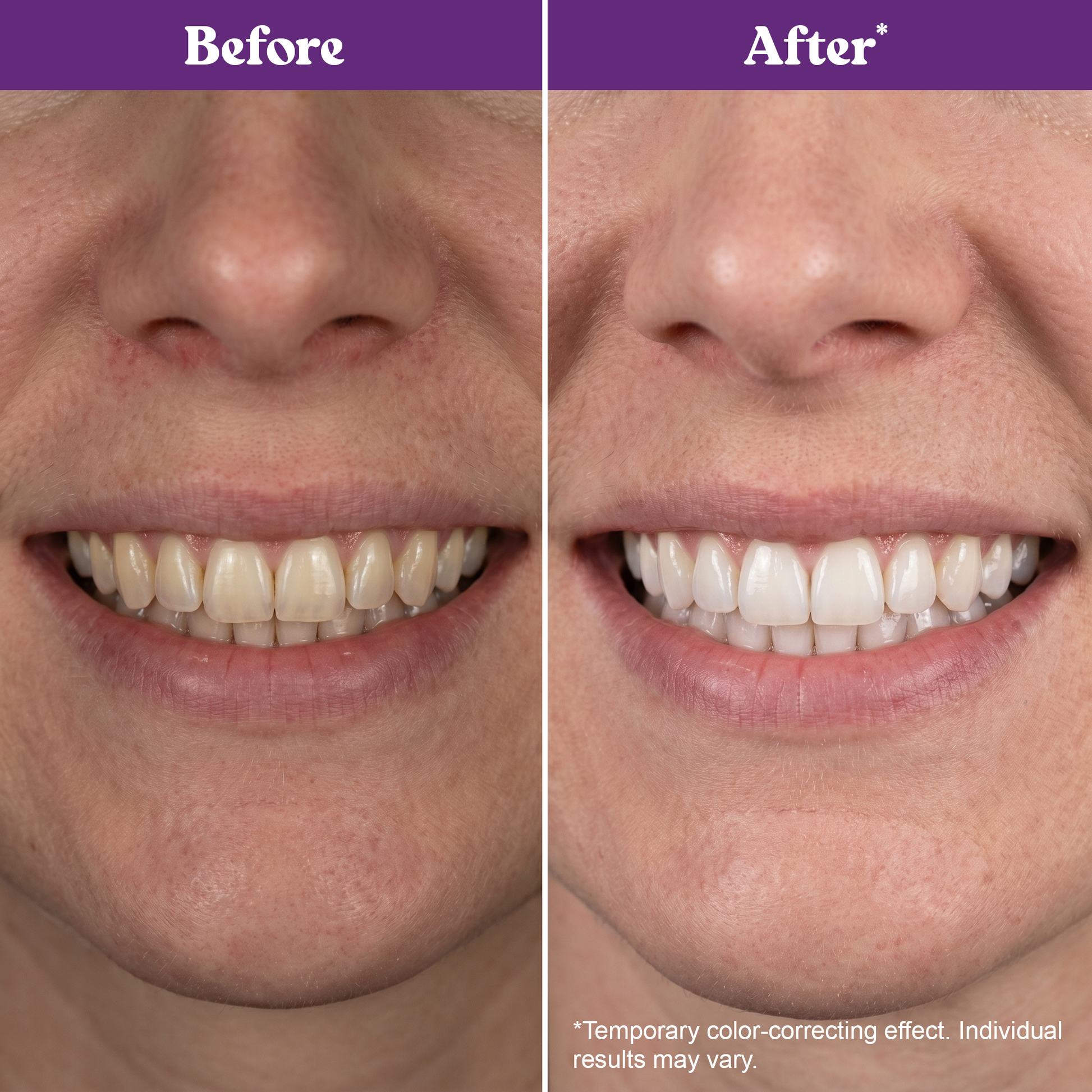 Healthy Purple Whitening Strips for Teeth - 28 Strips - Teeth Whitening Strips with PAP+ & Nano Hydroxyapatite - Enamel Safe, Low Sensitivity, Removes Stains Fast Dentagum